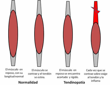 tendinopatia-normal