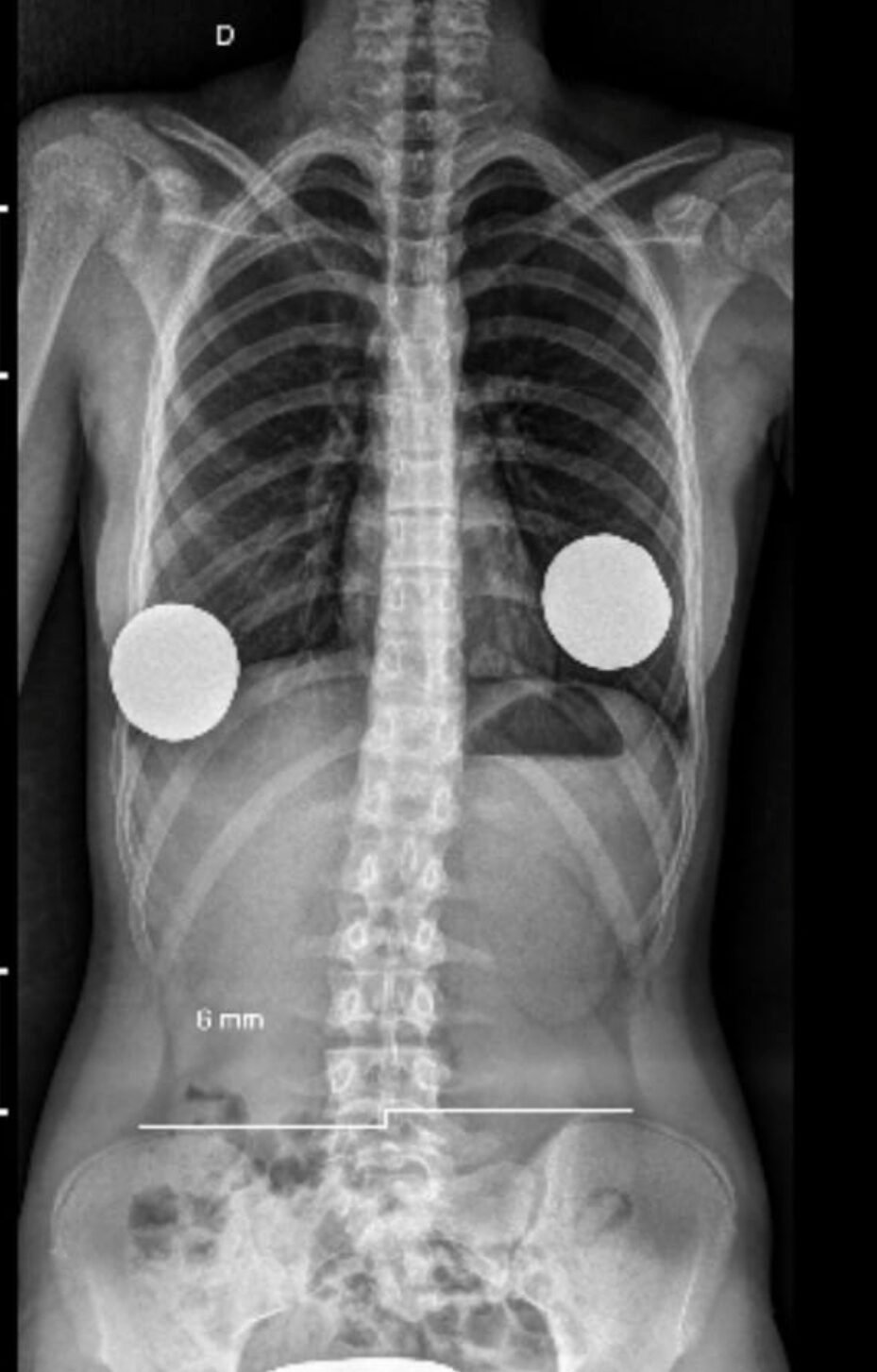ESCOLIOSIS1
