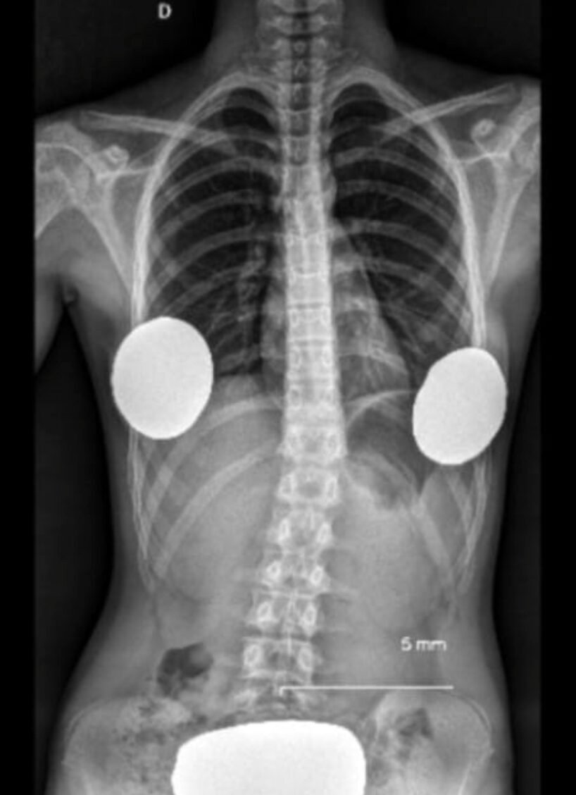 ESCOLIOSIS3
